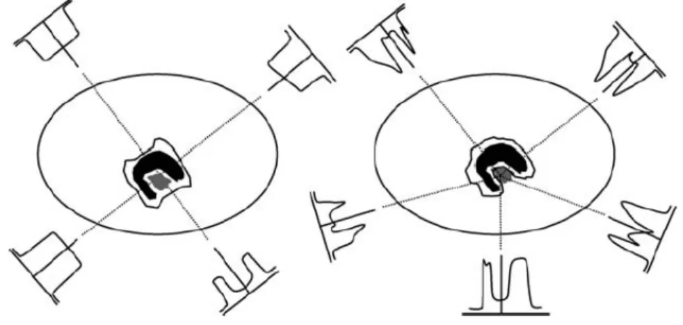 Figura 1.2: Confronto tra CRT (sinistra) e IMRT (destra). La capacità della CRT di alterare le linee di isodose è limitata dall’uso di MLCs e blocchi per la modulazione dei campi, di cunei per evitare tessuti e blocchi centrali per schermare gli organi cri