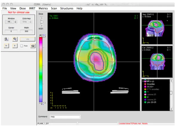 Figura 3.3: Esempio di una CT con piano di dose visualizzata in CERR