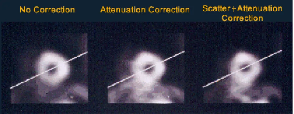 Figura 2.3 : confronto tra immagini SPECT non corrette, con correzione della sola attenuazione e  con correzione congiunta di scatter e attenuazione 