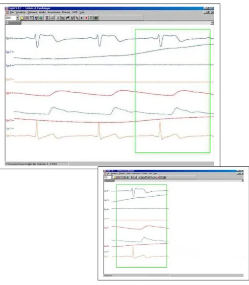 Fig.  4.4.  (In  alto)  Finestra  con  tracciati  in  tempo  reale.  Nel  rettangolo  in  verde  sono  evidenziati  gli    eventi  patologici  di  interesse