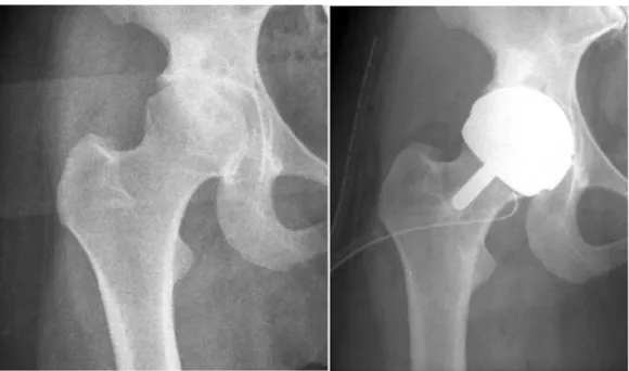 Figura 1.1: Radiografie di un’anca prima e dopo l’intervento di protesi. Nelle protesi di  rivestimento non è presente uno stelo vero e proprio e la parte femorale è una semisfera che riveste 