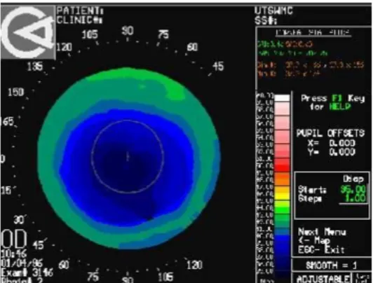 Figura 1-6 Tomografia di una cornea per la miopia 
