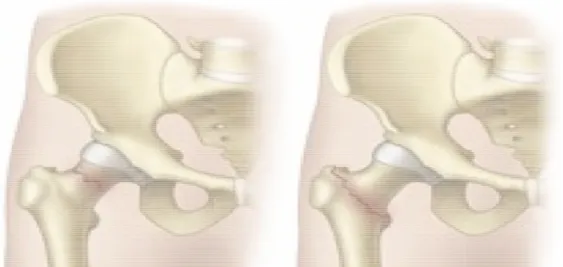 Figura 1.6: Possibili fratture del collo del femore.