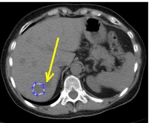 Figura 15: CT epatica con tracciamento ROI  su metastasi
