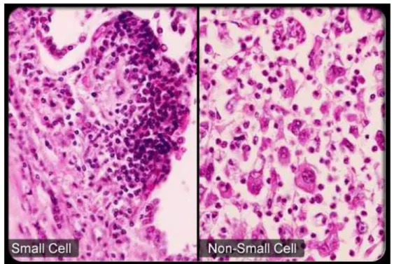 Figura  2.1  Confronto  istologico  tra  Carcinoma  Polmonare  a  Piccole  Cellule  (SCLC)  e  Carcinoma  Polmonare  Non  a  Piccole  Cellule  (NSCLC)  –  Tratta  da  www.emedicinehealth.com 
