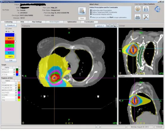 Figura 3.5 Print screen di un piano di trattamento per tumore al polmone 
