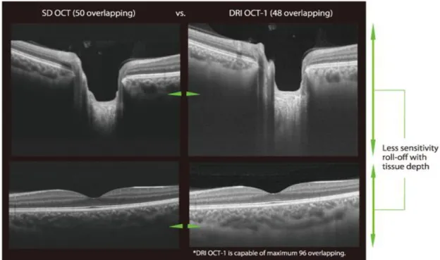 figura 25-confronto tra le immagini di fovea e disco ottico ottenute con la tecnologia SS-OCT (a  destra) e SD-OCT (a sinistra)