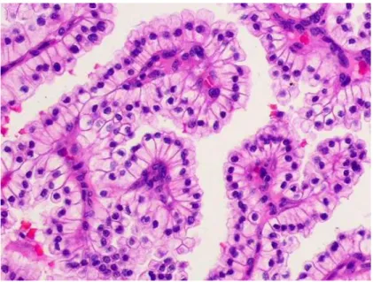 Fig. 1.3 Vetrino istologico di carcinoma renale 