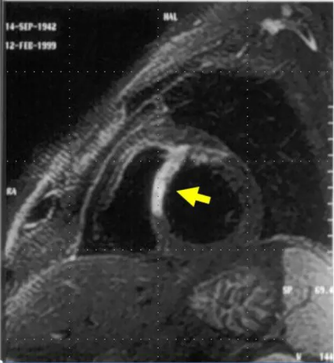 Fig 1.5: Immagine di  RM di infarto miocardico antero-settale studiato in  fase acuta