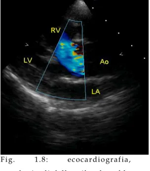 Fig. 1.7: rx toracica, c oartazione  aortica: restringimento  congenito dell’aorta. La freccia 