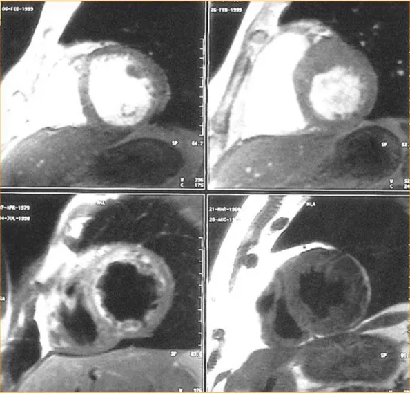 Fig. 1.9: RM asse corto. In alto a sinistra: cardiomiopatia dilatativa, in alto  a destra: cardiomiopatia ipertrofica, in basso a sinistra: cardiomiopatia  restrittiva, in basso a  destra: displasia aritmogena del ventricolo destro