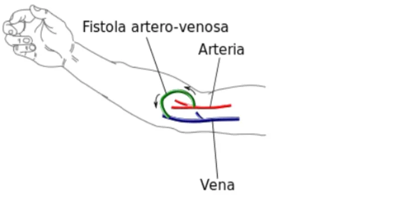 Figura 2: fistola artero-venosa                                                                                                