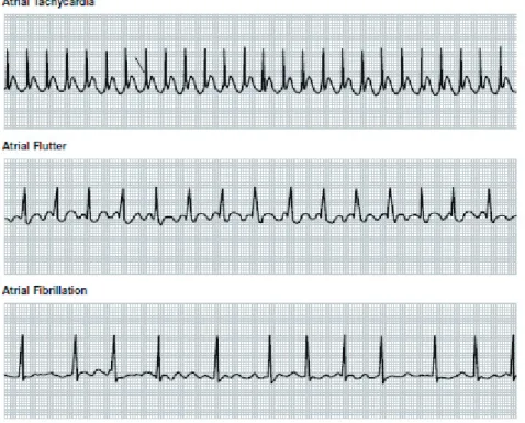Figura 2.5: alcune morfologie di tachicardie sopraventricolari.  Dall’alto: tachicardia atriale, flutter atriale, fibrillazione atriale.