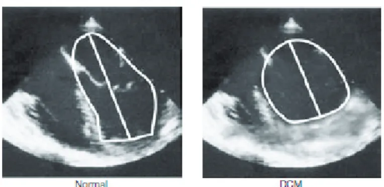 Figura 3.2: Ecocardiogramma mostrante la differenza fra un cuore normale e  uno con cardiomiopatia dilatativa, una conseguenza diretta della dissincronia 