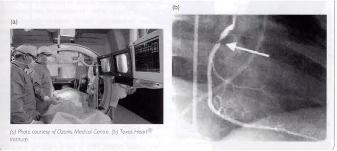 Figura 2.2: La coronarografia è una procedura non chirurgica diagnostica utilizzata su pazienti che  presentano dolore al torace