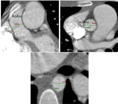 Figure 4.1: Different views of the ascending (AoAsc) and descending (AoDesc) aorta taken from computed tomography angiography are reported