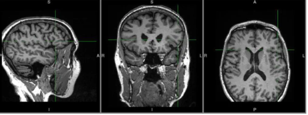 Figure 3: Example of healthy subject MRI 