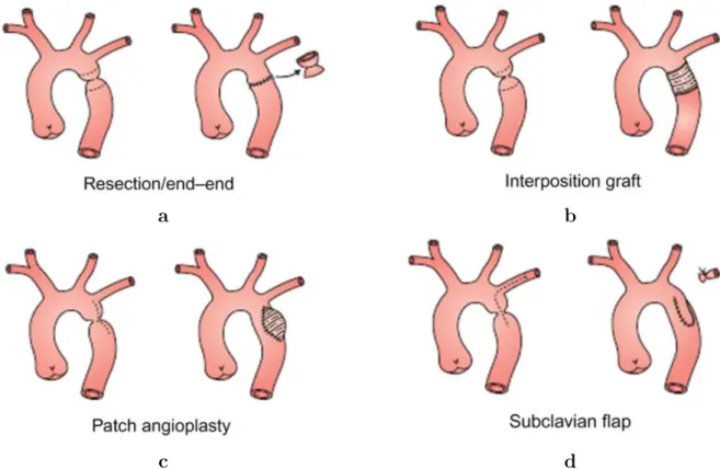 Figure 1.3: Schematic representations of the main surgical repair techniques for CoA [49]; end- end-end resection (a), graft interposition (b), patch angioplasty (c) and subclavian flap (d).
