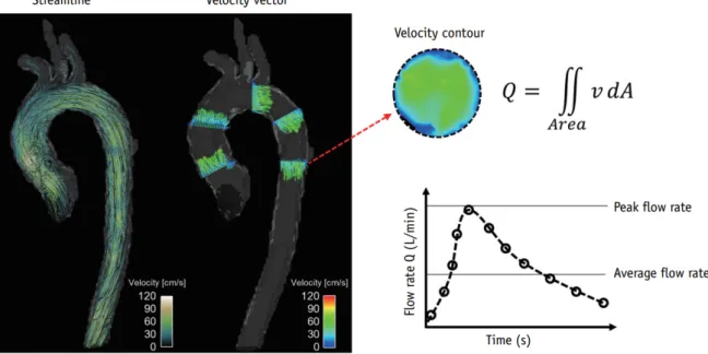 Figure 1.8: Example of velocity visualization and quantification of flow rate from 4D flow [8] .