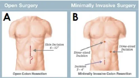Figure 1.1: Comparison between incisions necessary to perform colon resection: A) Open surgery.