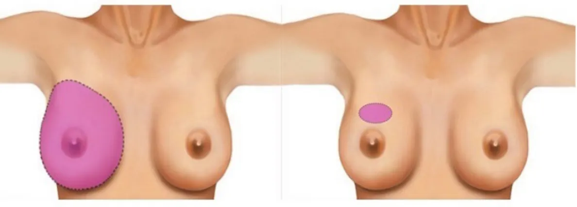 Figure 1.3: Dierent surgical approaches for breast cancer. On the left: mastectomy.