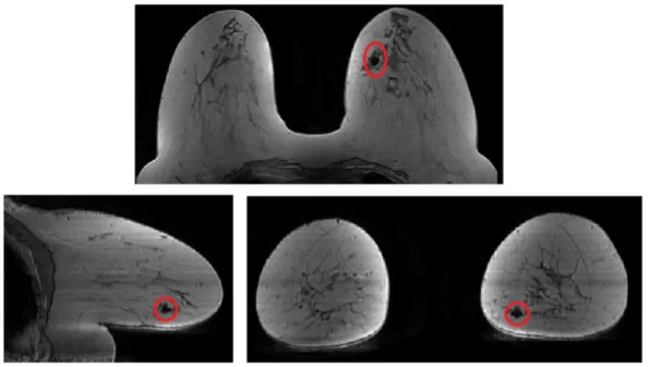 Figure 3.1: MRI of the breast on transverse, sagittal, and coronal plane, where the tumor was located manually by the surgeon (red circles).