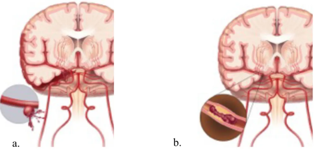 Fig.  2  Representation  of  the  brain  during  a  stroke.  In  the  left  brain  (a)  is  occurring an hemorrhagic stroke