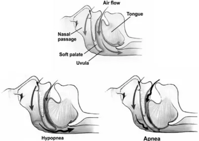 Figure 1.28 - Partial and complete airway obstruction resulting in hypopnoea and  apnoea