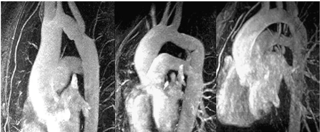 Figure  1.11  Different  morphologies  of  the  aortic  arch  after  surgical  CoA  repair  in  left  anterior  oblique  projection of MR images