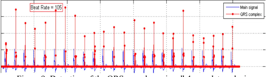 Figure 9: Detection of the QRS complex using db4 wavelet analysis 