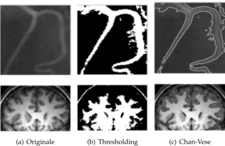 Figura 1.8: Errore di segmentazione per due immagini mediche (in alto una vena ai raggi X e in basso la RMN di un cervello)