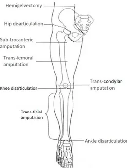 Figura 2-2. Tipologie di amputazione di arto inferiore. 