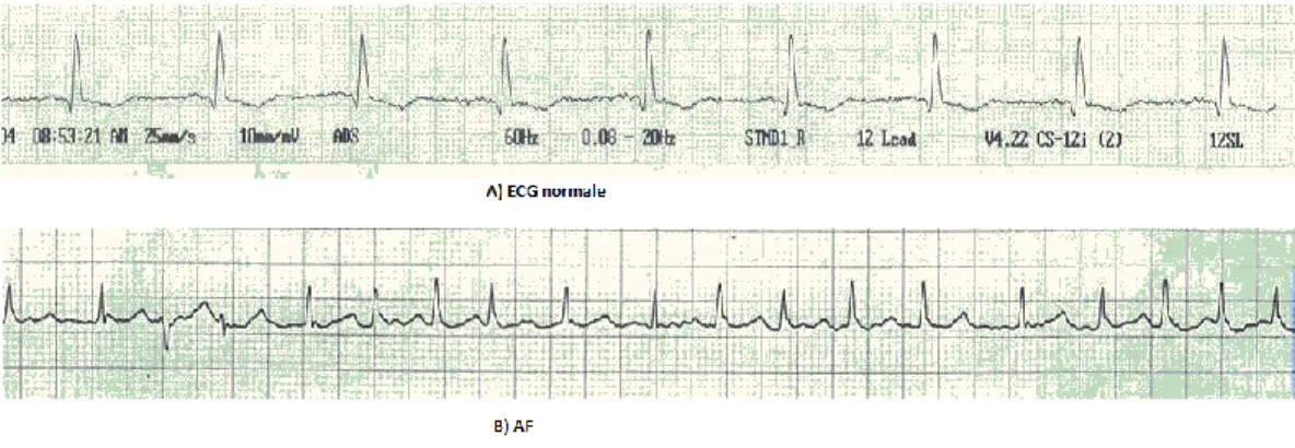 Figura  ‎ 1.6 La forma dell'onda ECG normale e AF 