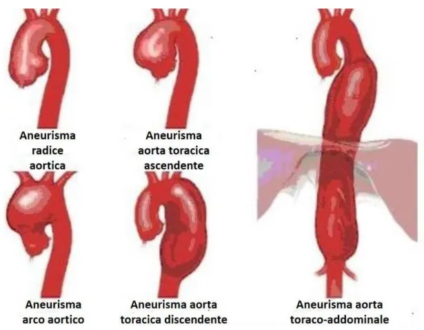 Figura 5: rappresentazione delle diverse tipologie di aneurisma aortico, in funzione della zona interessata