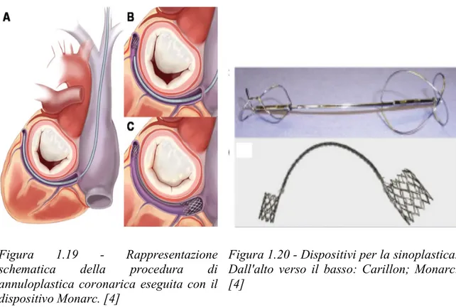 Figura  1.19  -  Rappresentazione  schematica  della  procedura  di  annuloplastica coronarica  eseguita con  il  dispositivo Monarc