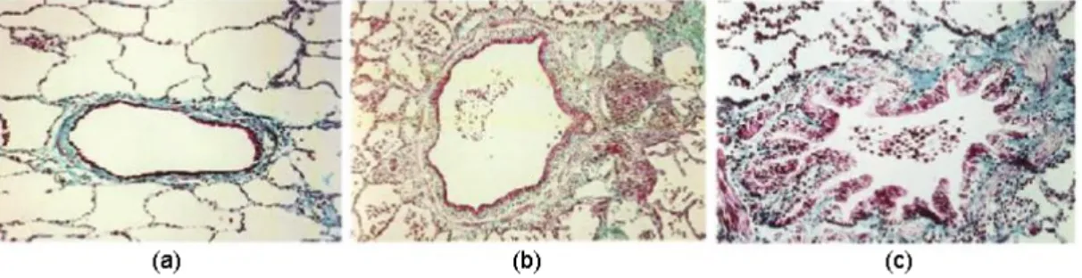 Figure 1.3: Histological section of peripheral airways. (a) Section from a sigarette smoker with normal lung function showing a nearly normal airway with small number of inflammatory cells