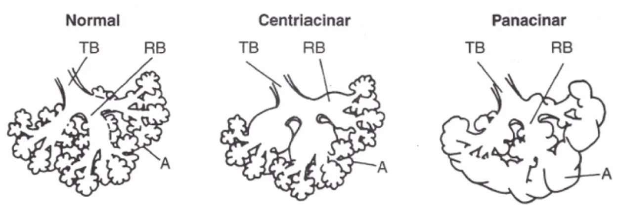 Figure 1.4: Centriacinar and panacinar emphysema. Notice that in centriacinar em- em-physema the destruction is confined to the terminal and respiratory bronchioles (TB and RB)
