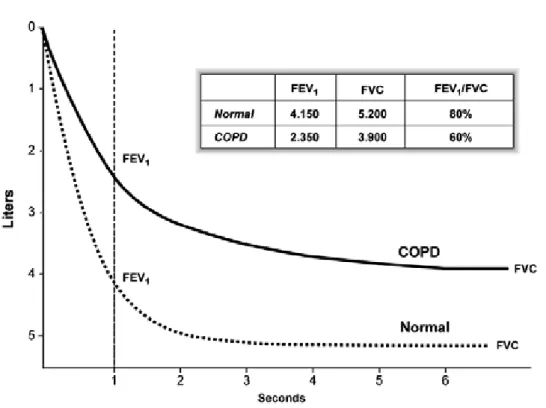 Figure 1.6: Normal spirogram and spirogram typical of patients with moderate COPD.