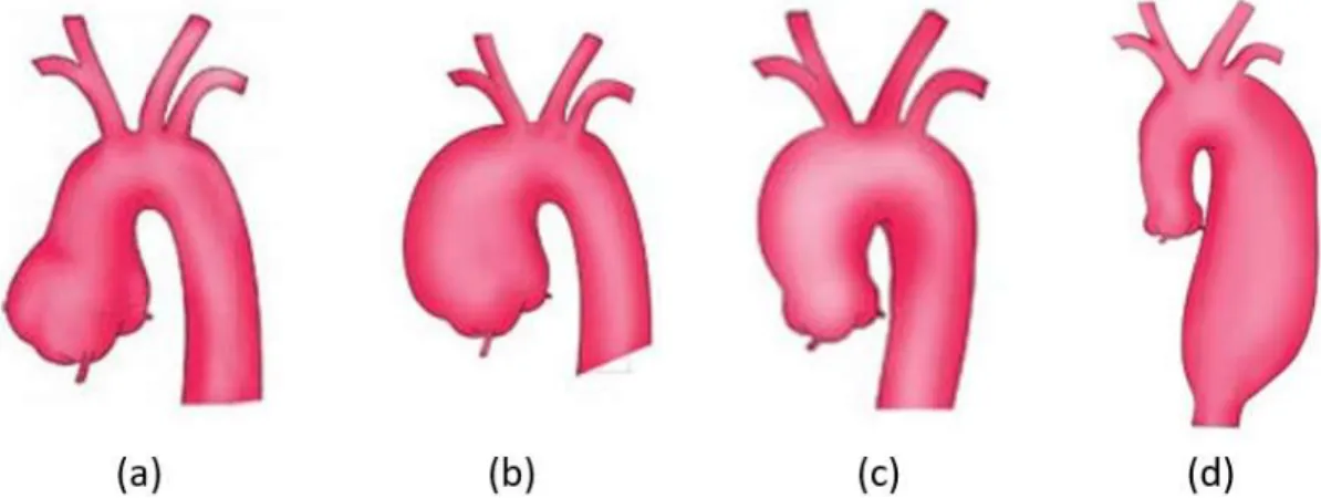 Figure 1.8. Classification of thoracic aortic aneurysm. From left to right: aortic root aneurysm (a), ascending aorta  aneurysm (b), aortic arch aneurysm (c) and descending aorta aneurysm (d)