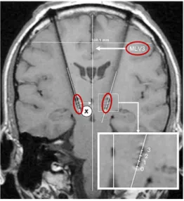Figure 2.6: Postoperative frontal spin-echo T1-wighted image for the determi- determi-nation of the x coordinate (mediolateral) of the electrodes' contacts