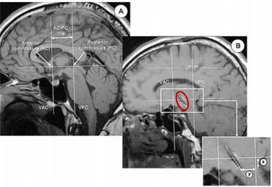Figure 2.7: (A): postoperative sagittal SET1 MRI slice for measurement of the AC-PC line, reference axis for z coordinate determination