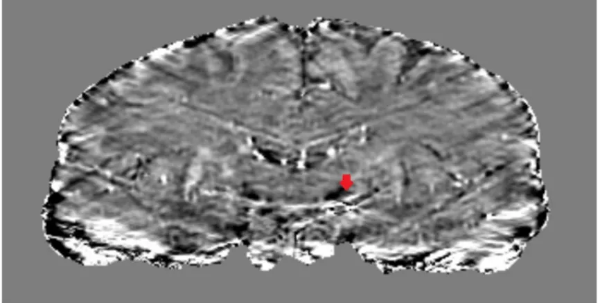 Figure 1.4: Streaking artifacts in QSM image from our database (coronal view)