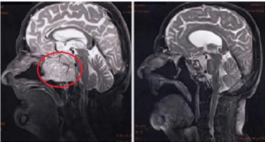 Fig. 1.10: Il cordoma (cerchiato in rosso), molto visibile prima del trattamento, risulta  praticamente sparito dopo sei mesi 