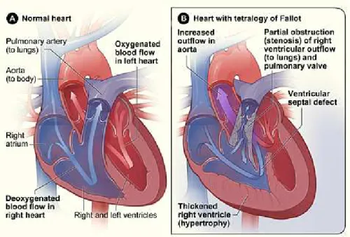 Figura 1.15 Struttura e flusso sanguigno in un cuore sano e uno affetto da tetralogia di Fallot