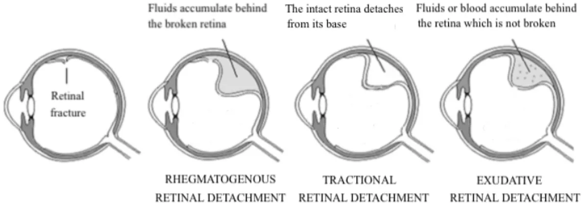 Figure 6 Types of retinal detachment 