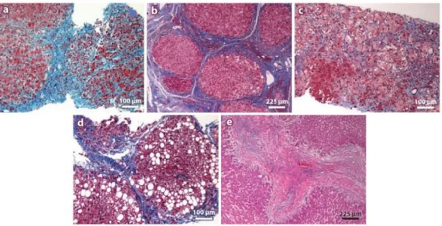Figure 1.7  Chronic exposure of the liver to injury from viral hepatitis, alcohol abuse or non-alcohol related  factor causes repeated hepatocyte damage and sets up a vicious cycle of cell death and proliferation, which  results in fibrotic condition and c
