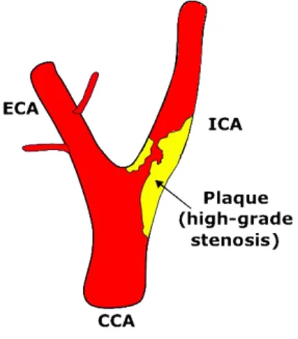 Figure 1.2: High grade stenosis (&gt;70%) in the internal carotid artery.