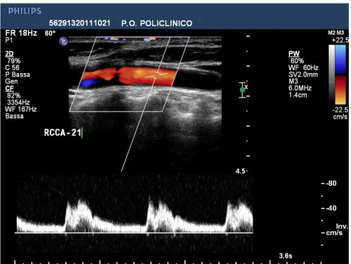 Figure 1.4: Echo-color doppler image corresponding to the central point of the carotid section located 2 cm before the carotid bifurcation.