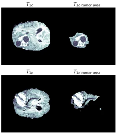 Figure 3.2. T 1c tumor slice in HG (above) and LG (below) subjects.