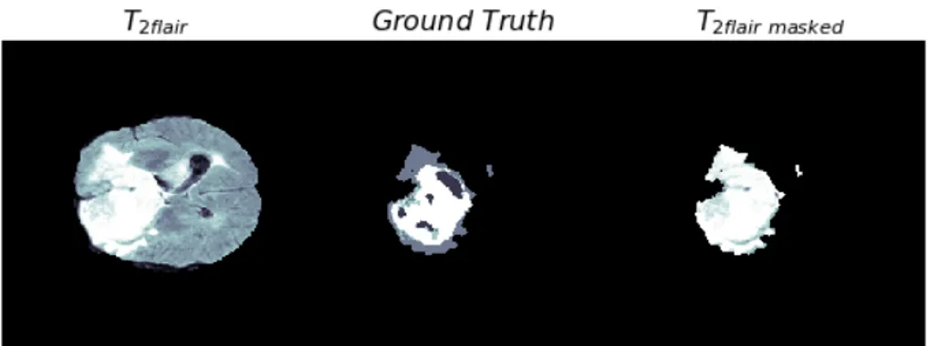 Figure 3.5. T 2flair masked : tumor area obtained using the Ground Truth as mask over T 2flair .